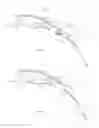 Fig. 02 - Tympansostomy tube and insertion device