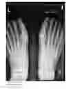 Fig. 01 - Methods of treating abnormalities of the first metatarsophalangeal joint of the foot
