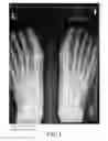 Fig. 02 - Methods of treating abnormalities of the first metatarsophalangeal joint of the foot