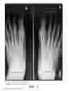 Fig. 03 - Methods of treating abnormalities of the first metatarsophalangeal joint of the foot