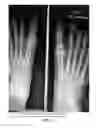 Fig. 04 - Methods of treating abnormalities of the first metatarsophalangeal joint of the foot