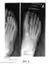 Fig. 06 - Methods of treating abnormalities of the first metatarsophalangeal joint of the foot