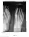 Fig. 07 - Methods of treating abnormalities of the first metatarsophalangeal joint of the foot