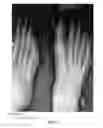Fig. 08 - Methods of treating abnormalities of the first metatarsophalangeal joint of the foot