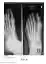 Fig. 09 - Methods of treating abnormalities of the first metatarsophalangeal joint of the foot