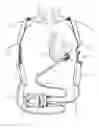 Fig. 01 - Methods and systems for upgrading ventricle assist devices