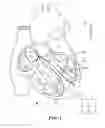 Fig. 02 - Multi-Site Ultrasonic Wireless Pacemaker-Defibrillator