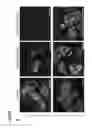 Fig. 16 - METHODS OF GENERATING NEPHRONS FROM HUMAN PLURIPOTENT STEM CELLS