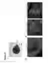 Fig. 26 - METHODS OF GENERATING NEPHRONS FROM HUMAN PLURIPOTENT STEM CELLS