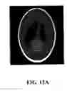 Fig. 14 - Single photon emission computed tomography imaging with a spinning parallel-slat collimator