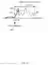 Fig. 15 - ABNORMAL WAVEFORM SENSING SYSTEM, ABNORMAL WAVEFORM SENSING METHOD, AND WAVEFORM ANALYSIS DEVICE