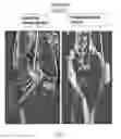Fig. 12 - Rodent embryonic stem cell with conditional ACVR1 mutant alleles