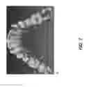 Fig. 09 - Structured light generation for intraoral 3D camera using 1D MEMS scanning