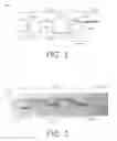 Fig. 02 - Vaso-occlusive device and delivery assembly