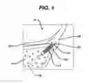 Fig. 02 - Glenoid anchor guide