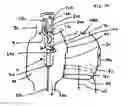 Fig. 02 - Expandable cardiac access catheter