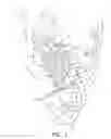 Fig. 02 - METHODS FOR ACCESSING A LEFT VENTRICLE
