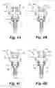 Fig. 04 - MONO TO POLY AXIAL UNIVERSAL PEDICLE SCREW AND METHOD OF USING THE SAME
