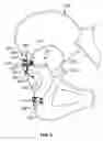 Fig. 06 - Augments and methods of implanting augments