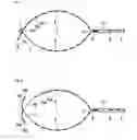 Fig. 02 - RF surgical resection snare for flexible endoscopy