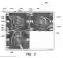 Fig. 07 - Systems and methods for determining leg length change during hip surgery