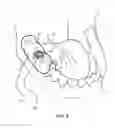 Fig. 02 - Implant placement key