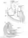 Fig. 02 - Systems and mechanisms for deploying a docking device for a replacement heart valve