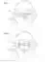 Fig. 06 - Systems and mechanisms for deploying a docking device for a replacement heart valve