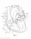 Fig. 02 - Mitral valve prosthesis implantation