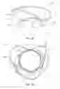 Fig. 07 - Mitral valve prosthesis implantation