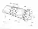 Fig. 01 - Low profile non-symmetrical stent