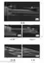 Fig. 07 - SYSTEMS AND METHODS FOR NEURAL DRUG DELIVERY AND MODULATION OF BRAIN ACTIVITY