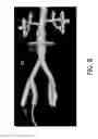 Fig. 07 - Hub for device placement with optical shape sensed guidewire