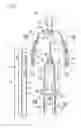 Fig. 02 - Treatment method using catheter assembly and catheter assembly