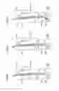 Fig. 09 - Treatment method using catheter assembly and catheter assembly