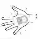 Fig. 13 - Securement device for medical devices