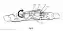 Fig. 34 - Securement device for medical devices