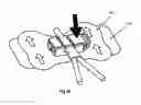 Fig. 35 - Securement device for medical devices