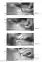 Fig. 04 - Subcutaneous implant delivery apparatus and method of delivering a subcutaneous implantable device for accessing a vascular site