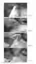 Fig. 07 - Subcutaneous implant delivery apparatus and method of delivering a subcutaneous implantable device for accessing a vascular site