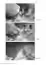 Fig. 08 - Subcutaneous implant delivery apparatus and method of delivering a subcutaneous implantable device for accessing a vascular site