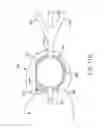 Fig. 35 - Minimally invasive methods for hemostasis in a bleeding closed tissue volume