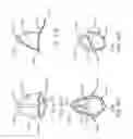 Fig. 75 - Minimally invasive methods for hemostasis in a bleeding closed tissue volume