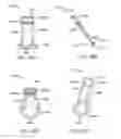 Fig. 79 - Minimally invasive methods for hemostasis in a bleeding closed tissue volume