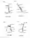 Fig. 83 - Minimally invasive methods for hemostasis in a bleeding closed tissue volume