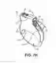 Fig. 14 - Adapter assemblies for implantable medical electrical systems