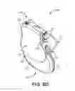 Fig. 17 - Adapter assemblies for implantable medical electrical systems