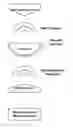 Fig. 01 - Breast Cup System and Method for Hyperthermic Anaerobic Cell Apoptosis