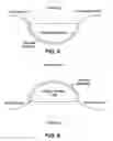 Fig. 05 - Breast Cup System and Method for Hyperthermic Anaerobic Cell Apoptosis