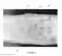 Fig. 04 - LOW DEFORMATION FILTER MEDIA